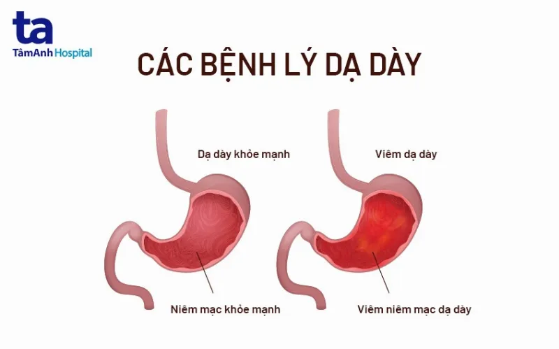 bệnh viêm dạ dày