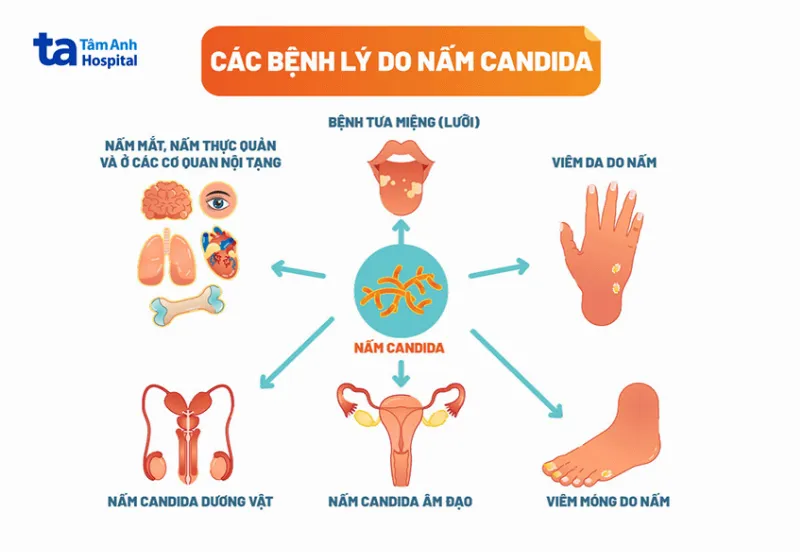 các bệnh lý do nấm candida