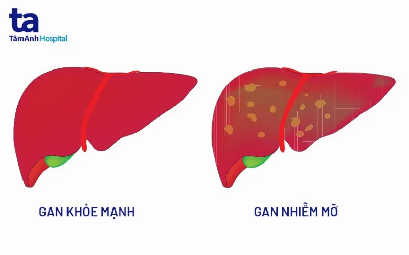 nguyên nhân gan nhiễm mỡ độ 1