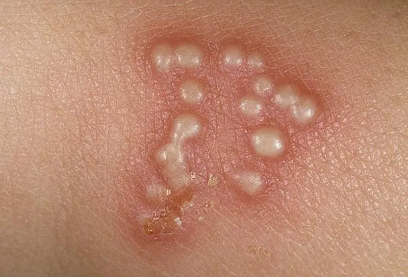 Viêm da bọng nước dạng Herpes